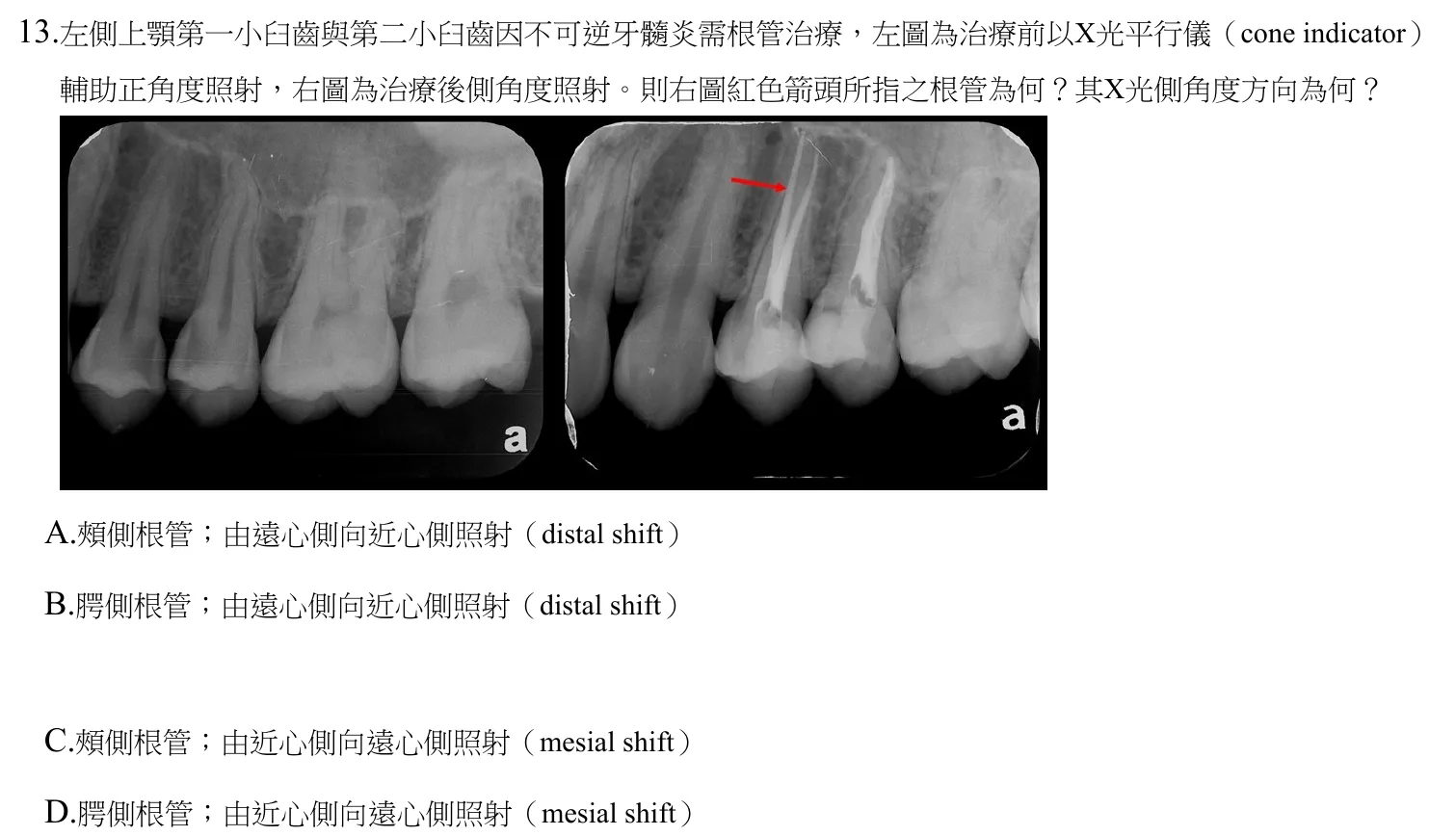 111 年第二次 牙醫學（三） 第 13 題附圖