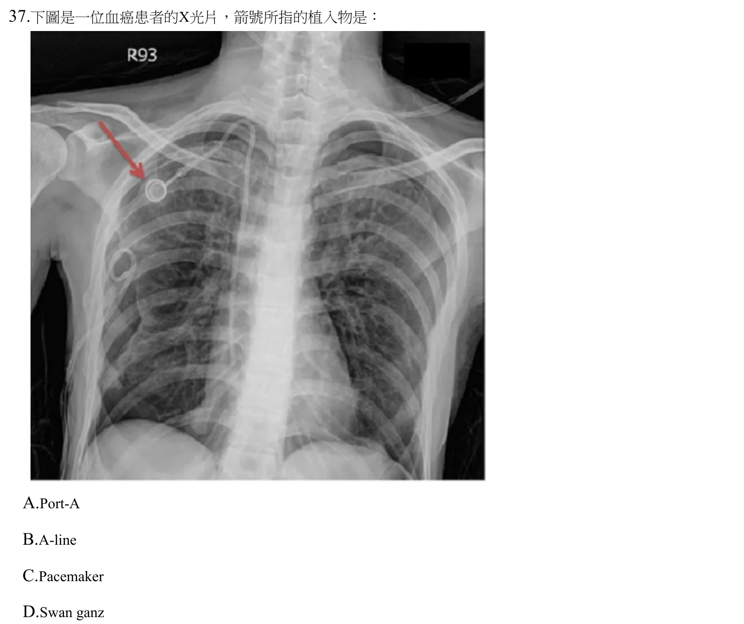 111 年第二次 心肺疾病與小兒疾病物理治療學 第 37 題附圖