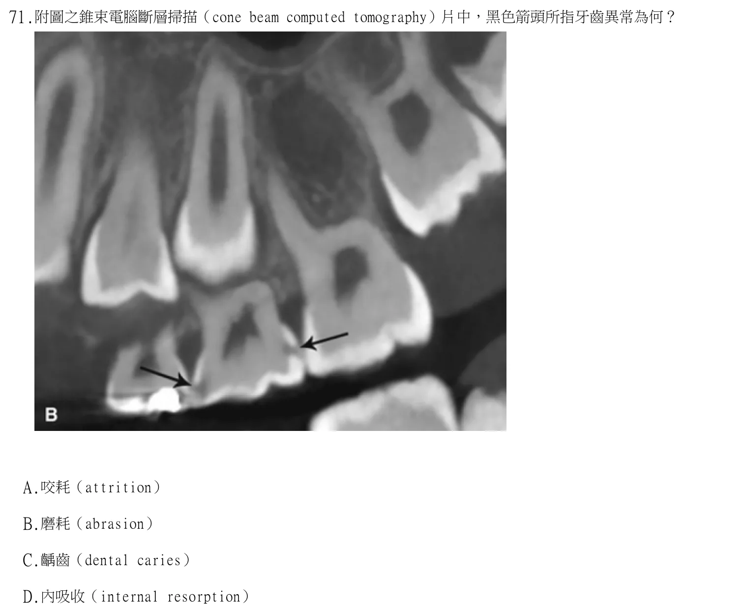 113 年第二次 牙醫學(四) 第 71 題附圖