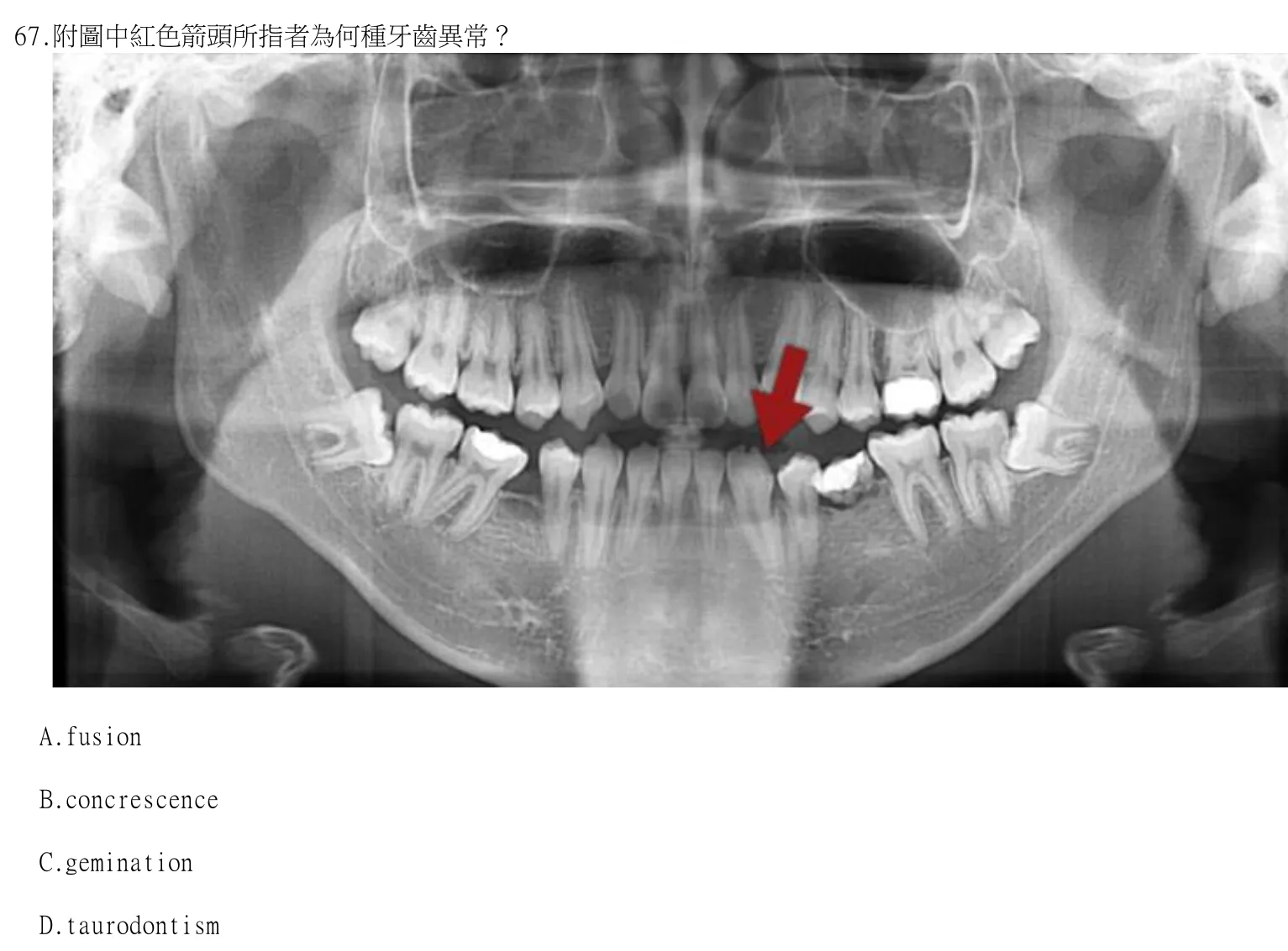 114 年第一次 牙醫學（四） 第 67 題附圖