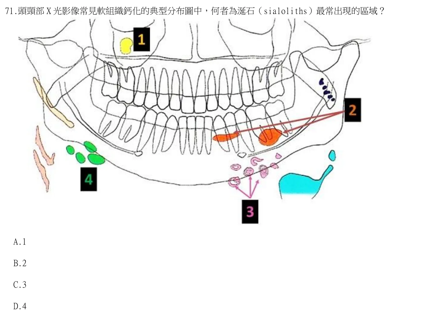 114 年第一次 牙醫學（四） 第 71 題附圖