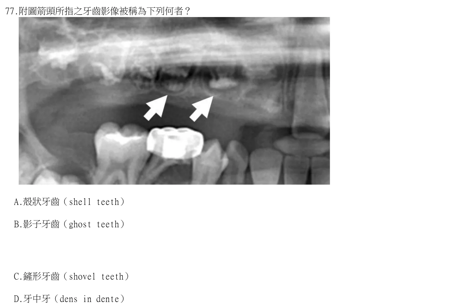 114 年第二次 牙醫學（四） 第 77 題附圖