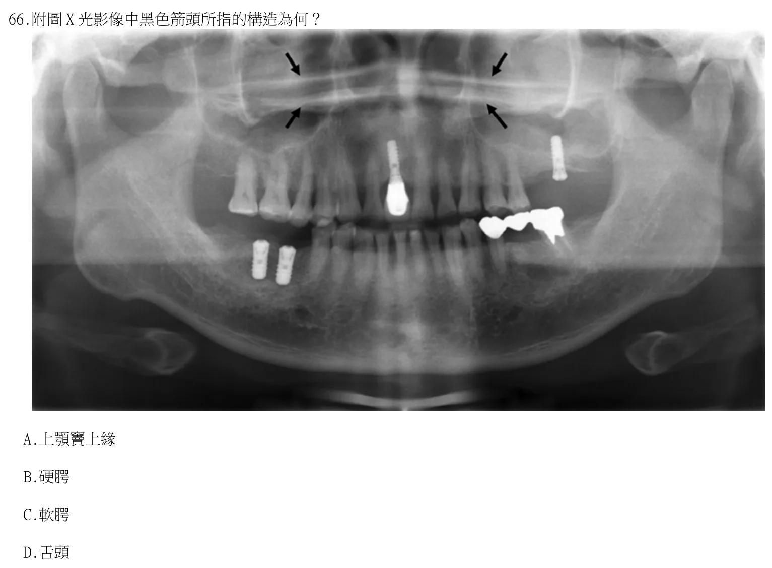 115 年第二次 牙醫學(四) 第 66 題附圖